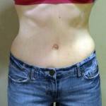 Tummy tuck weight requirements before