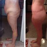 Tummy tuck weight requirements before and after