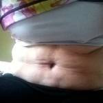 Tummy tuck weight requirements for surgery