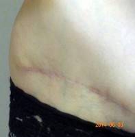 Mini tummy tuck uk scar