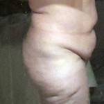 Tummy tuck scar photos Atlanta GA top plastic surgeons images