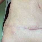 Tummy tuck scar photos Baltimore best cosmetic surgeons images