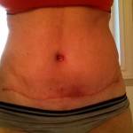 Tummy tuck scar photos Baltimore top best cosmetic surgeons
