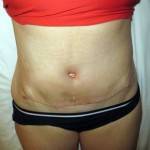 Tummy tuck scar photos Georgia best cosmetic surgeons pictures