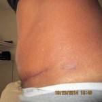 Tummy tuck scar photos Houston Texas cosmetic surgeons pictures