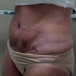 Tummy tuck scar photos Houston top best plastic surgeons images