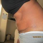Tummy tuck scar photos Jacksonville Florida surgeons shapshots