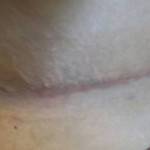 Tummy tuck scar photos Jacksonville fl best cosmetic surgeons photos