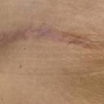 Tummy tuck scar photos New York City top plastic surgeons photos