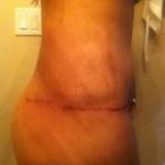 Tummy tuck scar photos San diego surgeons pics
