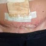 Tummy tuck scar photos San diego top best plastic surgeons photos