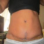 Tummy tuck scar photos after pregnancy picture