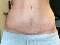 Tummy tuck scar photos after surgery