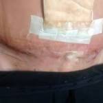 Tummy tuck scar photos after weight loss