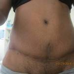 Tummy tuck scar photos after weight loss images