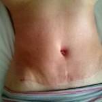 Tummy tuck scar photos and liposuction surgery image