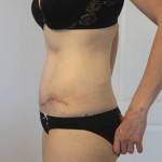 Tummy tuck scar photos operation picture