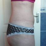 Tummy tuck scar photos recovery timeline pictures