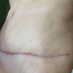 Tummy tuck scar photos scar treatment picture