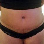 Tummy tuck scar photos scars pictures