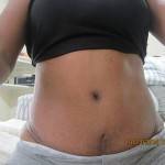 Tummy tuck scar photos stretch marks pictures