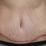 Tummy tuck scar photos with lipo operation images