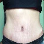 Tummy tuck scar photos with lipo operation photos