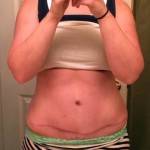 Tummy tuck scar photos with liposuction procedure pic