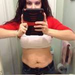 Hernia surgery and tummy tuck picture