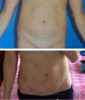 Hysterectomy after tummy tuck operation