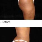 Tummy tuck photos before and after Florida top plastic surgeons images