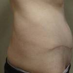 Tummy tuck photos before and after Houston surgeons pics