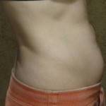 Tummy tuck photos before and after San diego plastic surgeons pictures
