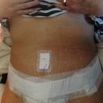Tummy tuck photos before and after Texas surgeons images
