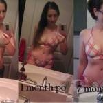 Tummy tuck photos before and after abdominal surgery