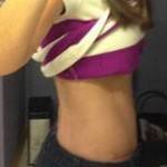 Tummy tuck photos before and after after pregnancy image
