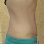 Tummy tuck photos before and after belly button pictures