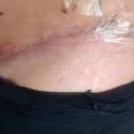 Tummy tuck photos before and after belly button scars images