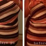 Tummy tuck photos before and after drains images