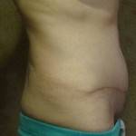 Tummy tuck photos before and after liposuction procedure picture