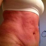 Tummy tuck photos before and after of pain photos