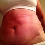 Tummy tuck photos before and after realself photo