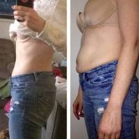 Tummy tuck photos before and after recovery in 6 months