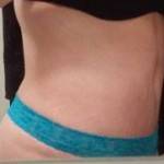 Abdominoplasty vs tummy tuck Charlotte nc top best plastic surgeons pictures