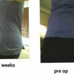 Abdominoplasty vs tummy tuck Charlotte nc top plastic surgeons photos