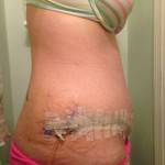 Abdominoplasty vs tummy tuck Houston plastic surgeons