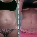 Abdominoplasty vs tummy tuck full pics