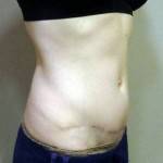 Abdominoplasty vs tummy tuck of natural
