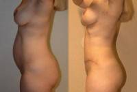 Before and after Tummy tuck umbilical hernia
