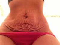 Board certified tummy tuck after pregnancy surgeons
